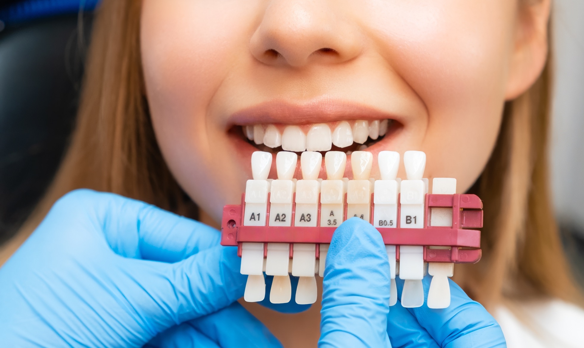 Branqueamento Dentário